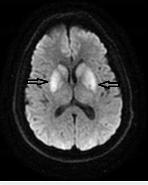 Mri Brain Axial Dwi Showing Restricted Diffusion In Bilateral Basal