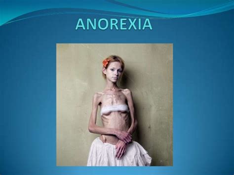 Anorexia Que Es