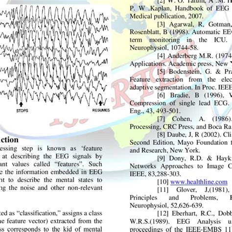 Electroencephalogram Demonstrating Benign Rolandic Epilepsy Note The