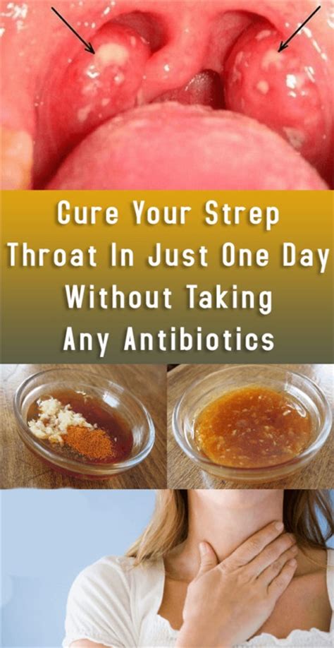Treat Your Painful Strep Throat In Only One Day Without Needing To