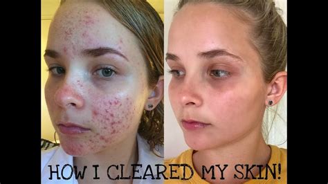 My Acne Story How I Cleared My Skin Youtube