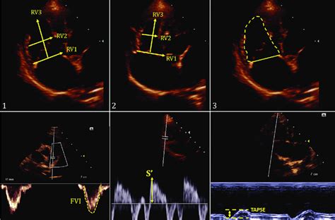Echocardiographic Images For Right Ventricle Evaluation 1 Linear