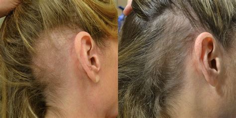 Platelet Rich Plasma Prp Before And After Photos Hair Restoration Of