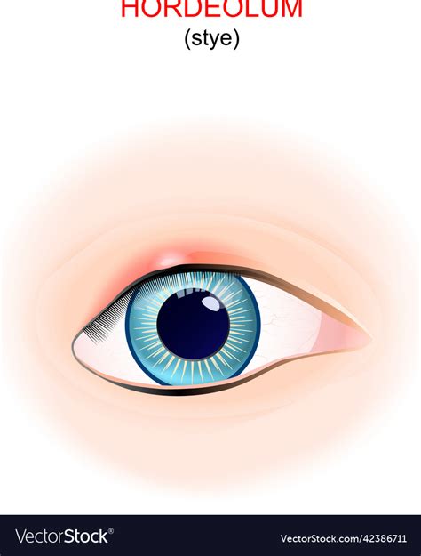 Stye Eye With Hordeolum On The Upper Eyelid Vector Image