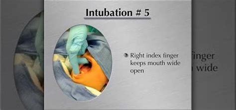 How To Perform An Endotracheal Intubation Medical Diagnosis