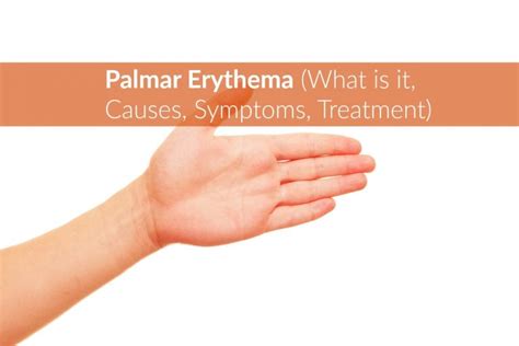 Palmar Erythema What Is It Causes Symptoms Treatment The Healthy