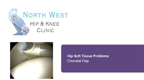 Hip Pain What Is A Chondral Flap Soft Tissue Hip Problems Youtube