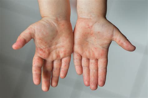 Hand Foot Mouth Disease Causes Symptoms And Treatment