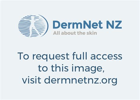 Erythema Nodosum Images Dermnet New Zealand