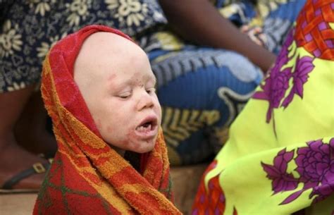 Tanzania Bans Witch Doctors To Deter Albino Killings