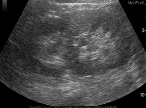 Coronal Ultrasound Image Of The Right Kidney Showing Ab Open I