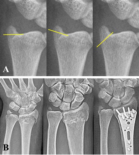 Factors Predictive For Union Of Basal Fracture Of The Ulnar Styloid Process After Distal Radial