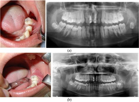 Multidisciplinary Management Of Benign Jaw Tumors In Children Intechopen