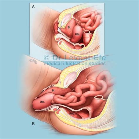 Medical Illustration Uterine Fibroids And Polyps Medical Art Medical