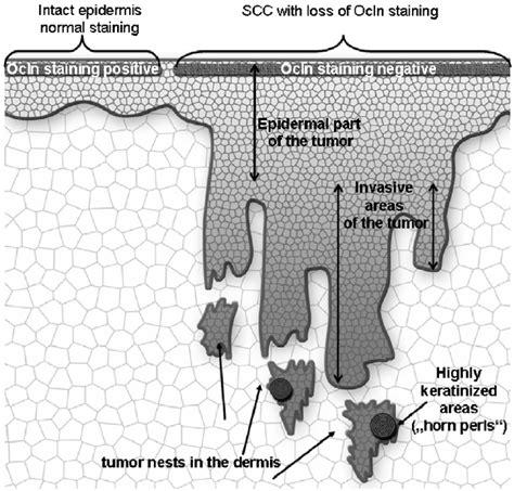 Schematic Drawing Of A Squamous Cell Carcinoma Denoting