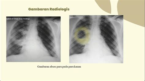 Gamabaran Radiologi Abses Paru Youtube