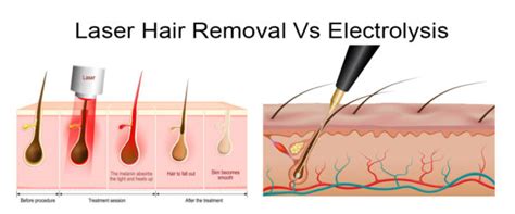 Electrolysis Vs Laser Hair Removal Choosing The Method For Lasting Results