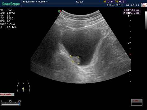 Диета при узи мочевого пузыря Узи Мочевого Пузыря Фото — Картинки фотографии Узи Мочевого Пузыря Фото — Картинки фотографии Диета при узи мочевого пузыря