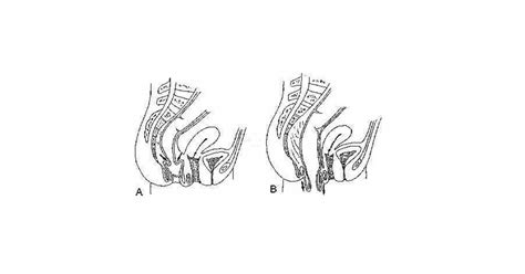 Rectal Prolapse Symptoms Causes And Treatment Psychology