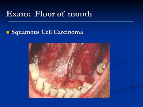Ppt Examination Of The Oral Cavity Powerpoint Presentation Free