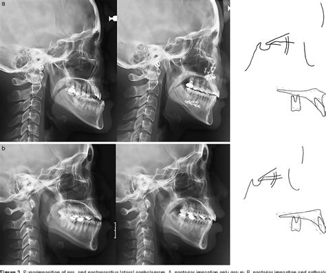 Figure From Effect Of Posterior Impaction And Setback Of The Maxilla On Retropalatal Airway