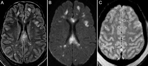 Dai is one of the most common and devastating types of traumatic brain injury and is a major cause of unconsciousness and persistent vegetative state after. Diffuse axonal injury | Postgraduate Medical Journal