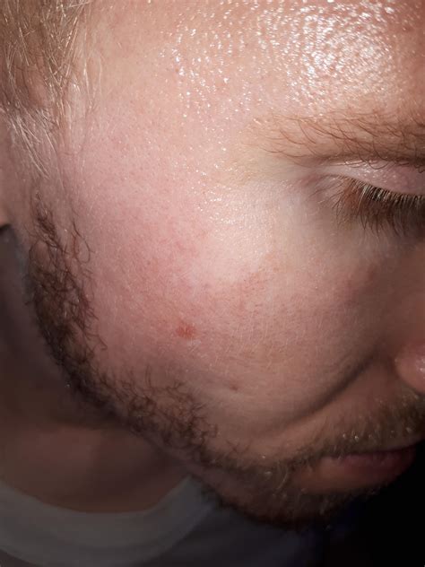 Skin Concerns What Are Exactly These Red Spots On My Cheek Freckles