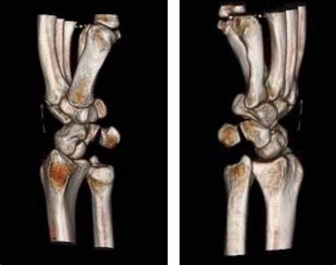 Cureus Isolated Volar Dislocation Of The Distal Radioulnar Joint