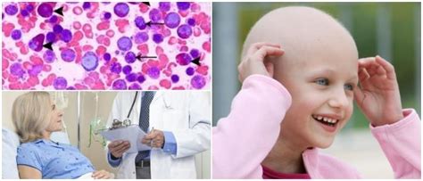 Leucemia Mieloide Crónica Causas Síntomas Diagnóstico Tratamiento Y