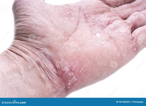 Psoriasis Skin Disease Stock Image Image Of Peeling 96768425