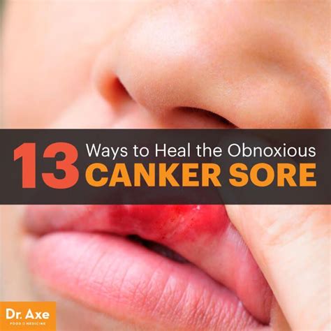 Canker Sore Symptoms Types Natural Remedies Dr Axe Canker Sore