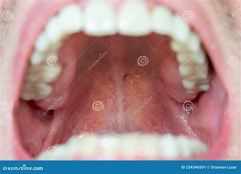 Back Of The Throat Roof Of The Mouth Macro Close Up View Of Caucasian Male Pharynx Stock Image