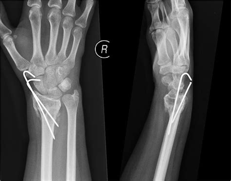 Ap And Lateral Plain Radiographs Of Right Wrist 6 Weeks After Fixation