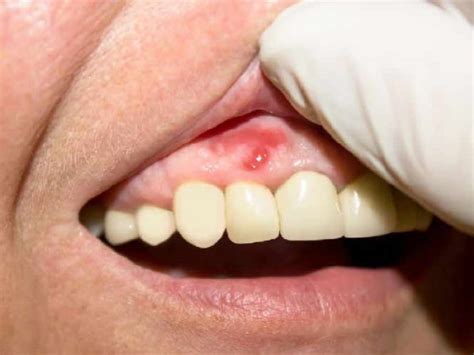 Severe Gum Pain Causes 14 Home Remedies And Treatment Education