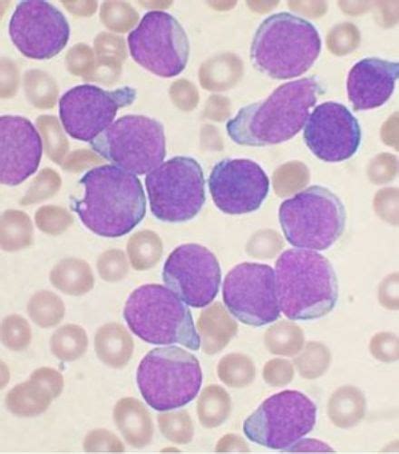 10 Facts About Leukemia Cancer Less Known Facts