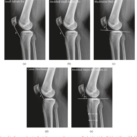 Figure 3 From Open Wedge High Tibial Osteotomy With Distal Tubercle