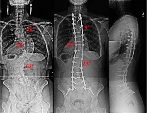 adult spinal deformity treatment surgery therapy nj and nyc