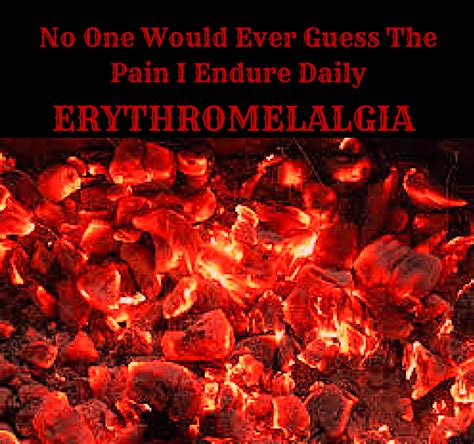 Pin By Erythromelalgia Warriors On Erythromelalgia Fibromyalgia