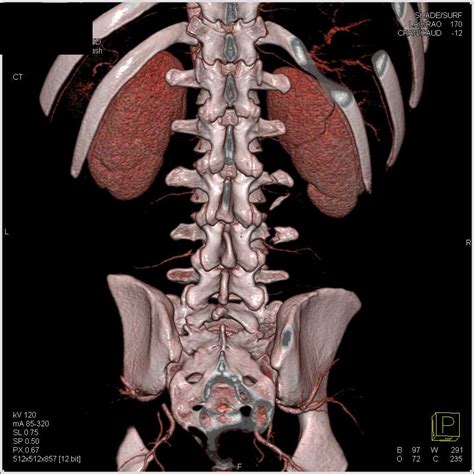 3d Imaging Of The Lumbar Spine Musculoskeletal Case Studies Ctisus