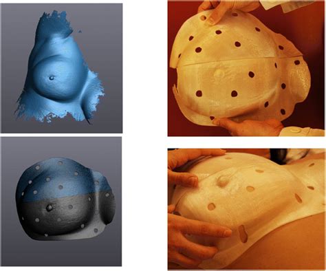 Improving 3d Printing Of Megavoltage X Rays Radiotherapy Bolus With