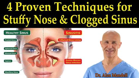 4 Proven Techniques For Stuffy Nose And Clogged Sinus Dr Alan Mandell