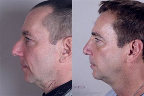 Rhinoplasty Before And After Pictures Case 146 Paramus Nj Parker