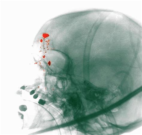 X Ray Showing A Gunshot Wound To The Head Digital Art By Callista