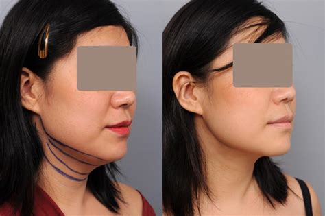 Smartlipo™ Chin And Neck Liposuction In New York