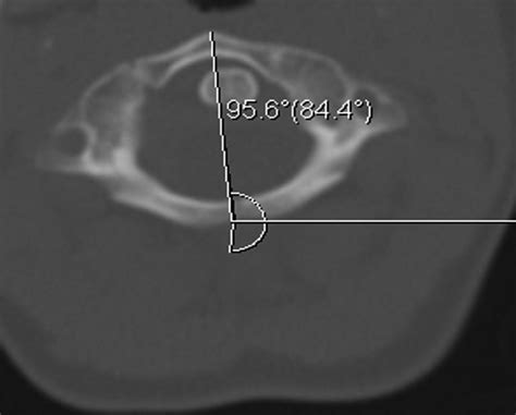 Asymmetry Of The Odontoid Lateral Mass Interval In Pediatric Trauma Ct