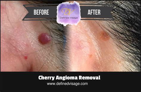 Cherry Angioma On Face Removal At Home Removing Cherry Angioma In 5