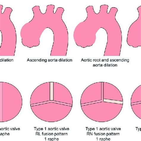 Aortic Dilation Phenotypes And Bicuspid Aortic Valve Bav Morphotypes