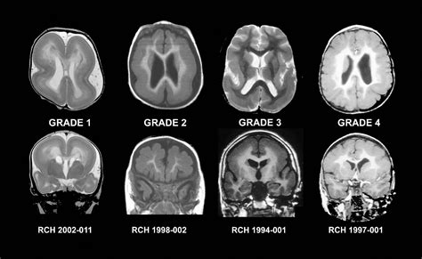Brain Magnetic Resonance Imaging Mri Revealed An Old