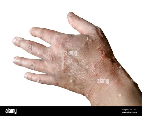 An Example Of A Chemical Burn On The Hand Skin Obtained From Such
