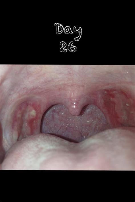 When Do The Scabs From A Tonsillectomy Fall Off